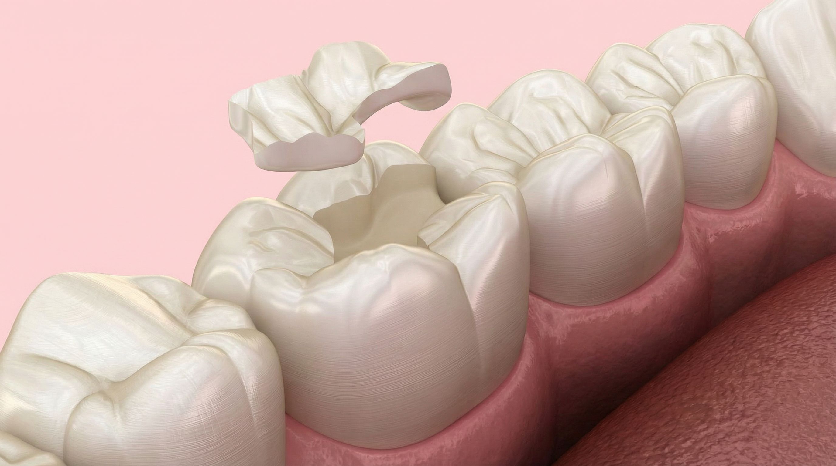 Ceramic onlay being placed to restore a damaged molar