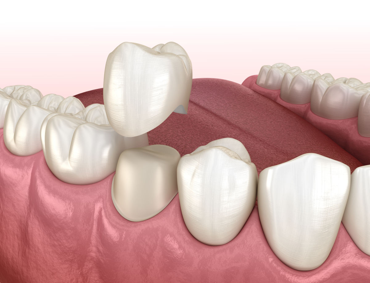 Dental crown being fitted onto a prepared molar after root canal treatment